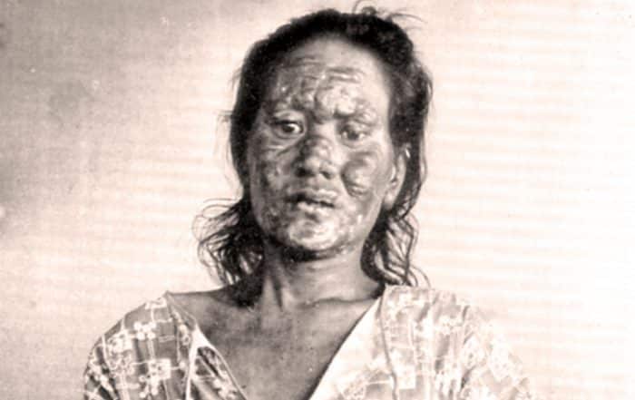 La lèpre royale, lépreuse de Taenga.